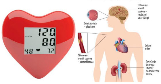 Povišeni krvni tlak (hipertenzija) | povišeni krvni tlak | šum u ušima | glavobolja |