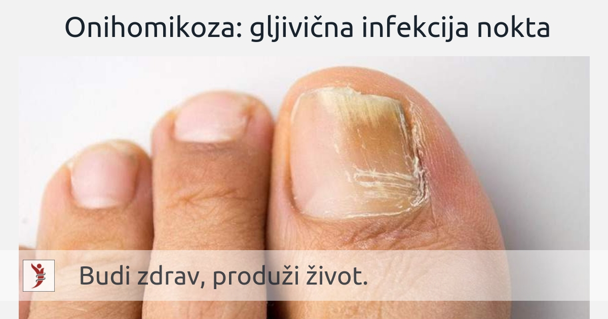 Onihomikoza: gljivična infekcija nokta