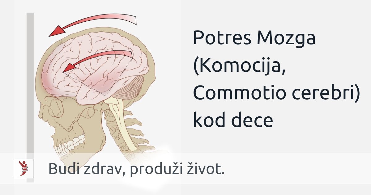 Potres Mozga (Komocija, Commotio cerebri) kod dece Foto: https://en.wikipedia.org/wiki/Concussion