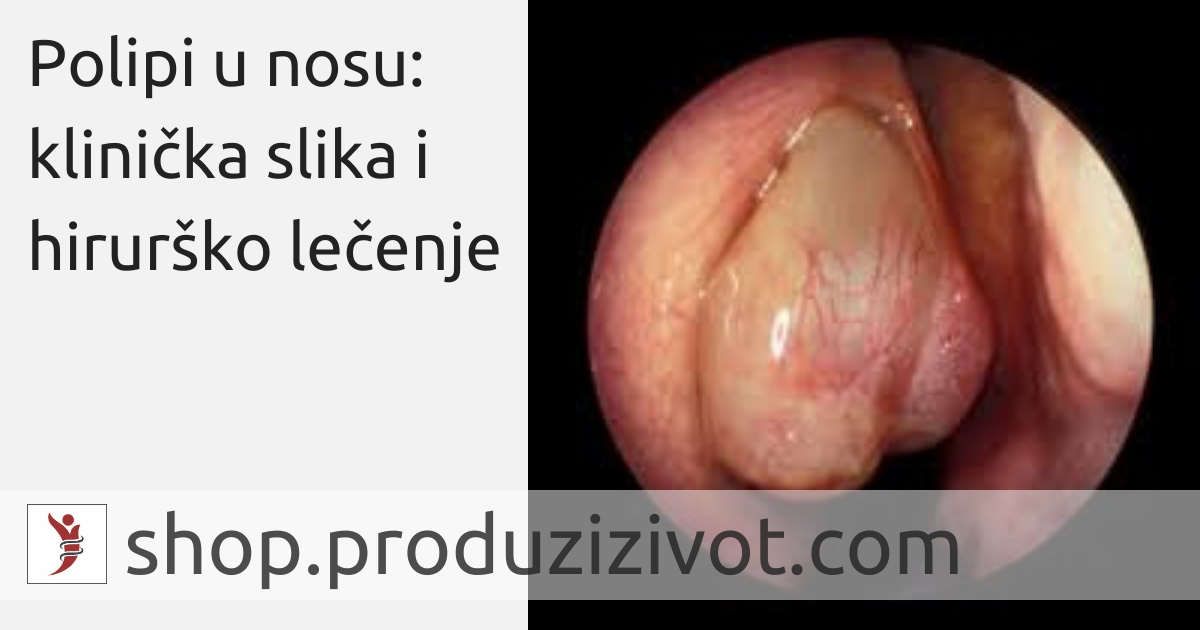 Polipi u nosu: klinička slika i hirurško lečenje; FOTO: http://rhinitis.hawkelibrary.com/album12/143_G?full=1