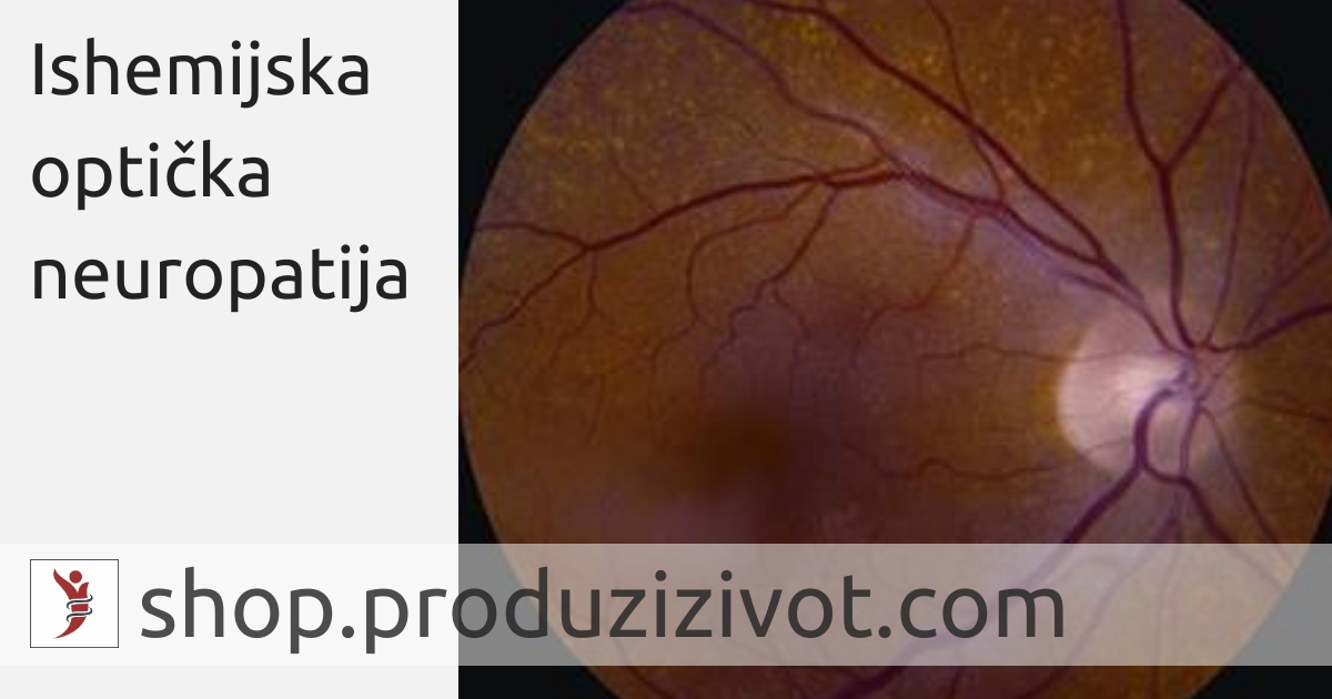 Ishemijska optička neuropatija; FOTO: https://www.aao.org/editors-choice/are-steroids-effective-in-nonarteritic-anterior-is