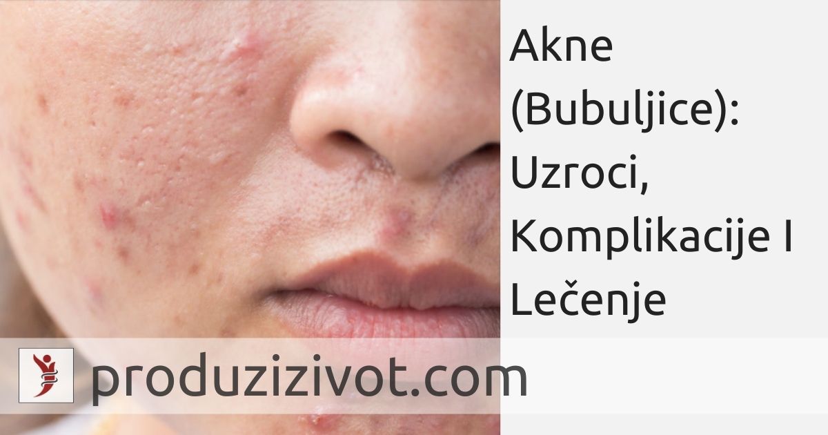 Akne (Bubuljice): Uzroci, Komplikacije I Lečenje; FOTO: https://www.insider.com/ways-to-clear-skin-according-to-experts-2018-6