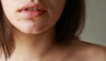 lice-vam-je-buknulo-i-imate-hormonske-akne?-pronasli-smo-najefikasnije-resenje,-provereno-radi-i-potpuno-je-prirodno