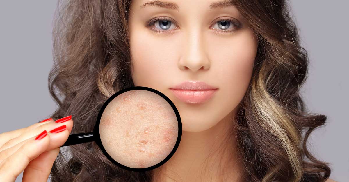 oziljci-od-akni-i-svi-nacini-za-njihovo-uklanjanje