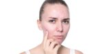 benzoil-peroksid-prava-stvar-za-vase-akne-ili-ne?