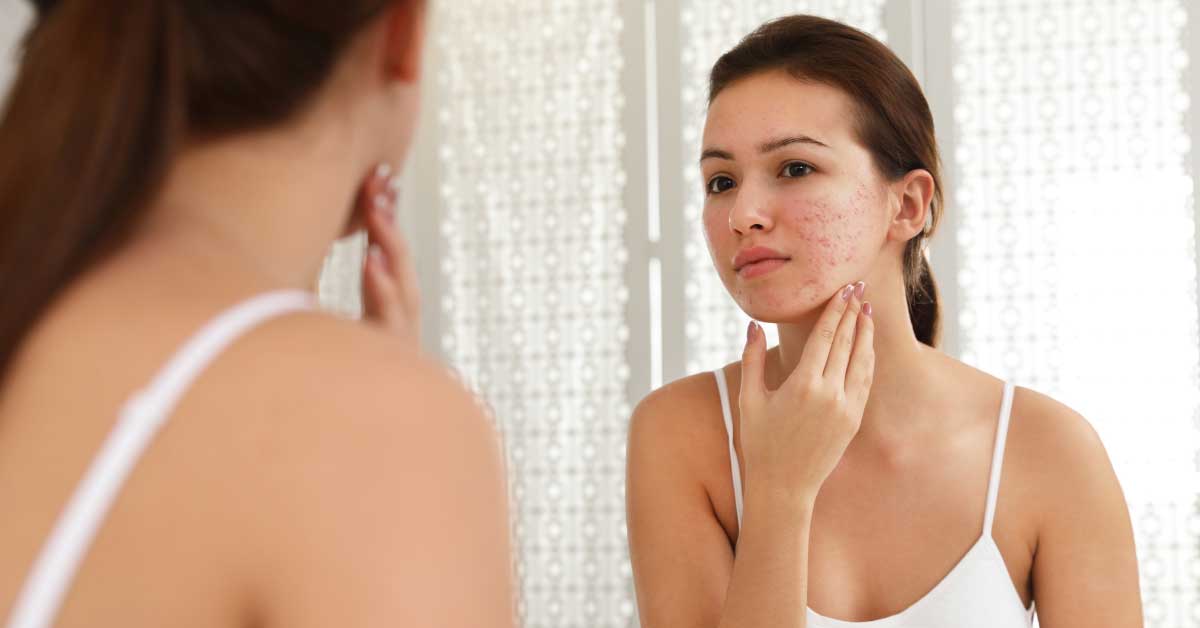 suva-koza-sklona-bubuljicama?-ima-resenja!