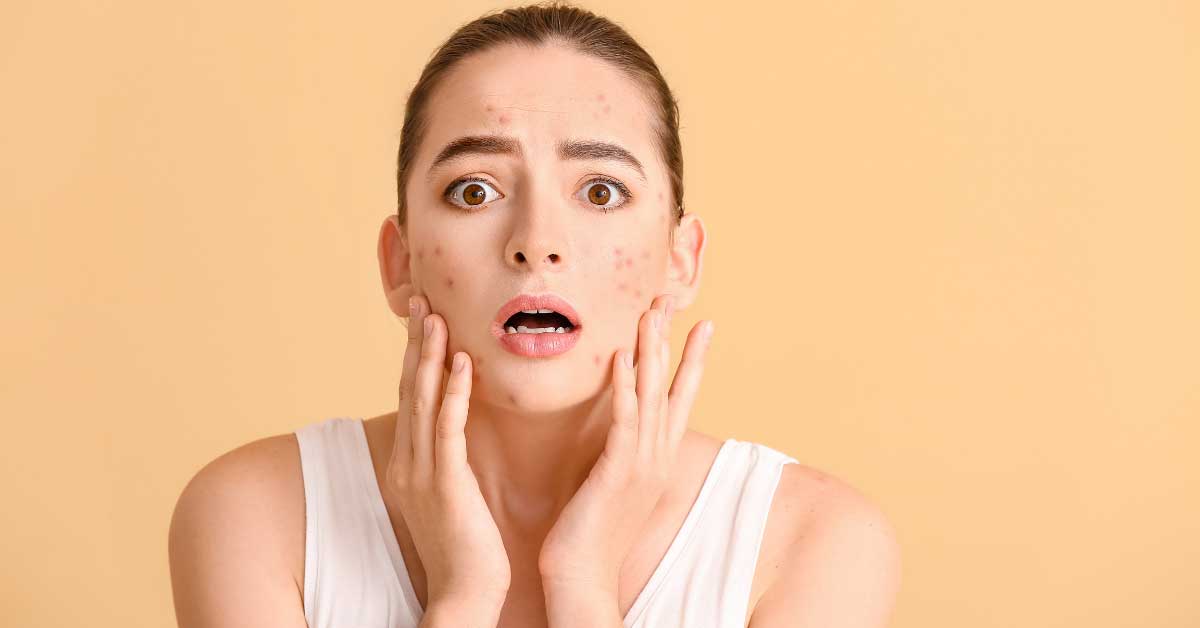 acne-vulgaris:-pojam,-simptomi-i-uklanjanje
