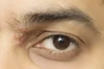 herpes-na-oku-–-simptomi,-lijecenje-i-prevencija
